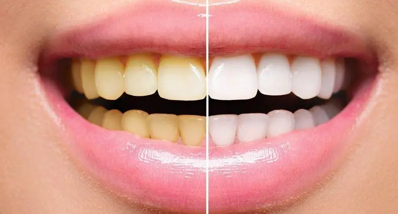 ¿Qué alimentos ponen los dientes amarillos?