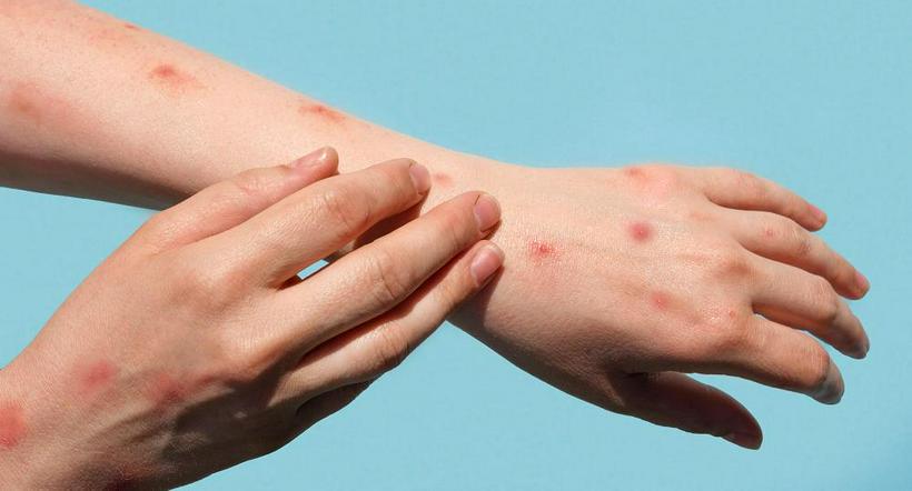 Contagios de varicela aumentaron en Antioquia: piden atención a los síntomas
