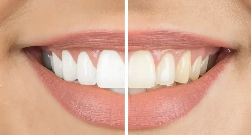 Consejos para mantener los dientes blancos sin necesidad de ningún procedimiento estético