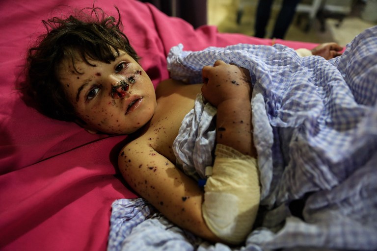 Una niña de 5 años resultó herida durante un bombardeo del ejército sirio. Pulzo.com