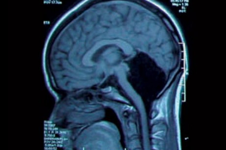 Radiografía de la cabeza con el espacio vacío en la parte posterior