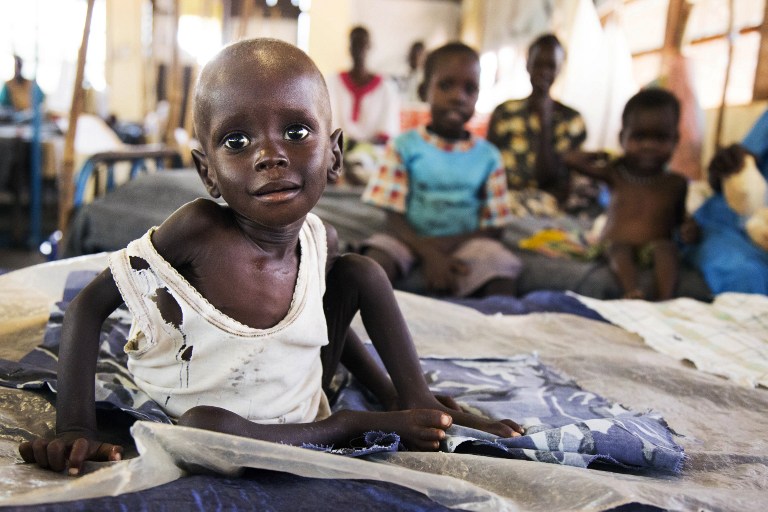 Niño malnutrido en Sudán del Sur. Pulzo.com
