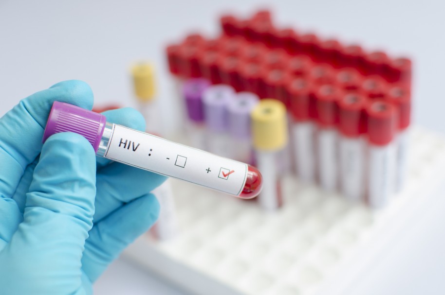 Muestra de sangre con VIH