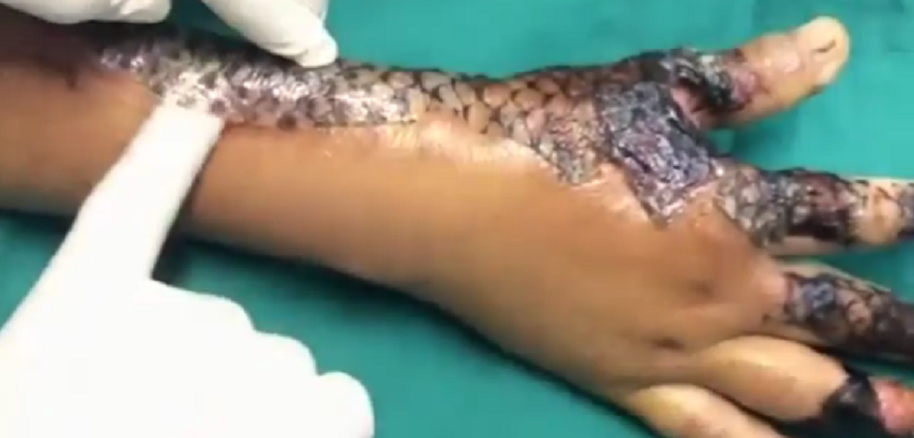 Piel de tilapia para curar quemaduras Piel de tilapia para curar quemaduras