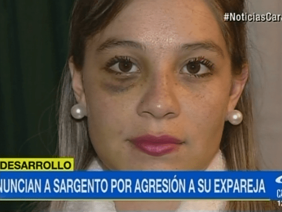 Así le quedó la cara a Angie Rodríguez luego de ser presuntamente golpeada por su expareja, un sargento del Ejército Nacional. Así le quedó la cara a Angie Rodríguez luego de ser presuntamente golpeada por su expareja, un sargento del Ejército Nacional.