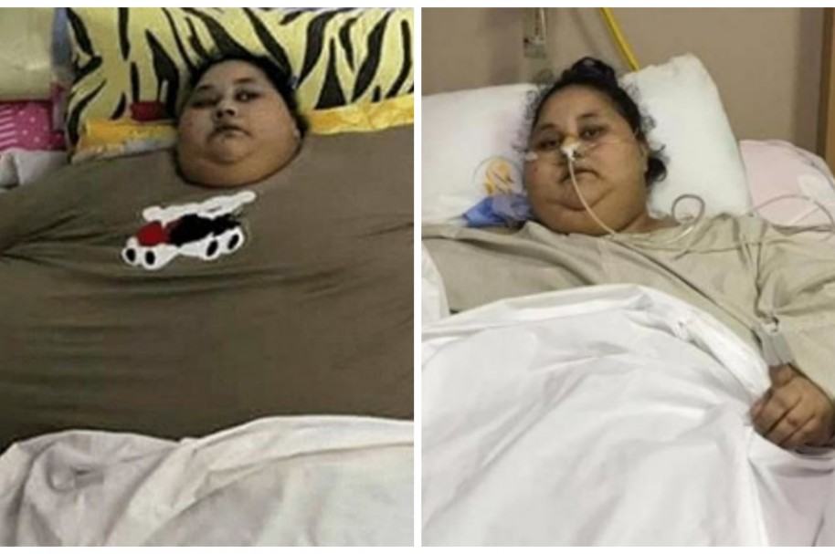 Mujer más obesa tras perder mitad de su peso