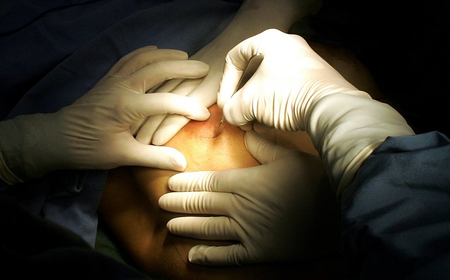 Cirugía de implante