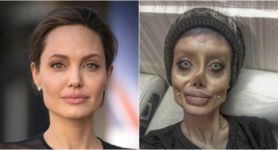 Joven se sometió a más de 50 cirugías para parecerse a Angelina Jolie