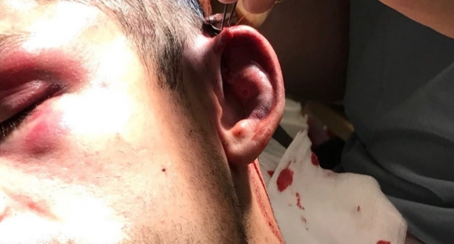 Boxeador casi pierde oreja