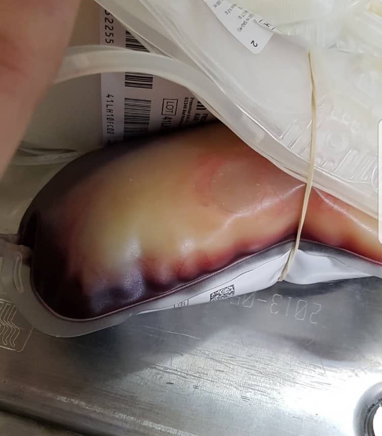 bolsa de sangre llena de grasa