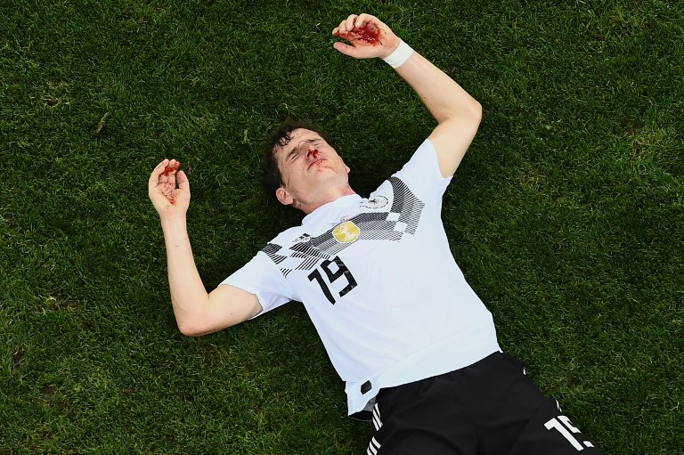 Sebastián Rudy tras recibir patada en su rostro. Sebastián Rudy tras recibir patada en su rostro.