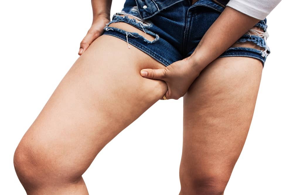 que es la celulitis en una pierna que es la celulitis en una pierna