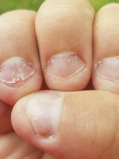 Uñas mordidas.