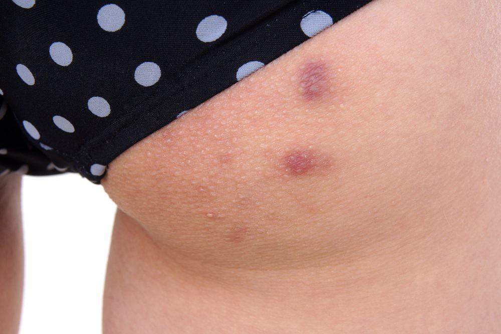 granos y espinillas en las piernas