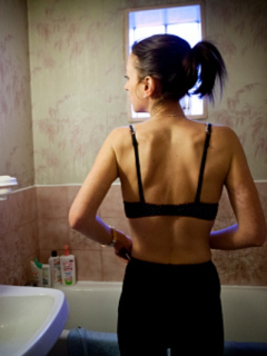 Anorexia