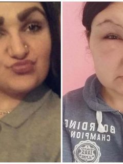 Mujer termina con la cara deformada.