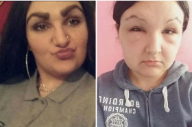 Mujer termina con la cara deformada.