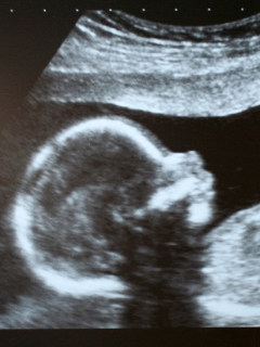 Feto se relaciona con el aborto
