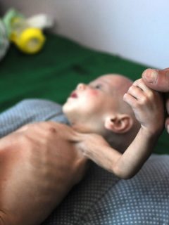 Niño yemení con desnutrición crítica