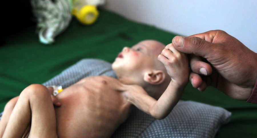 Niño yemení con desnutrición crítica