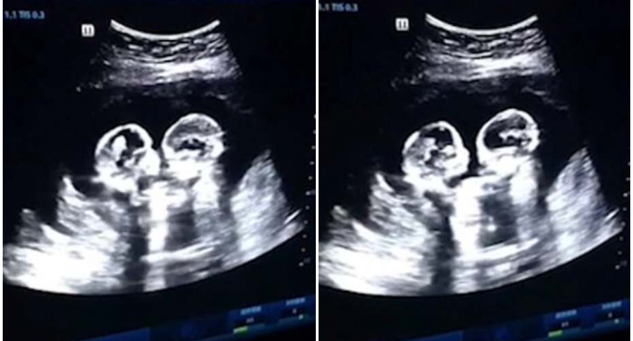 Gemelas en útero de la mamá.