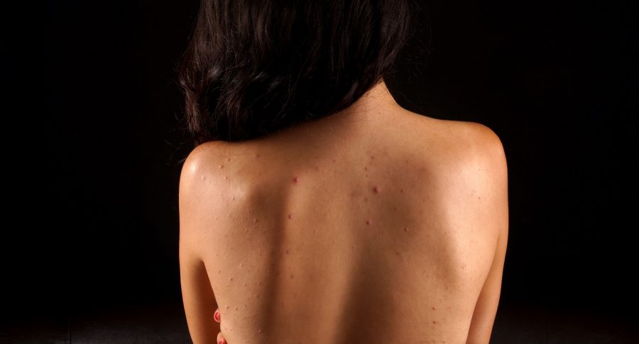 Mujer con acné en la espalda