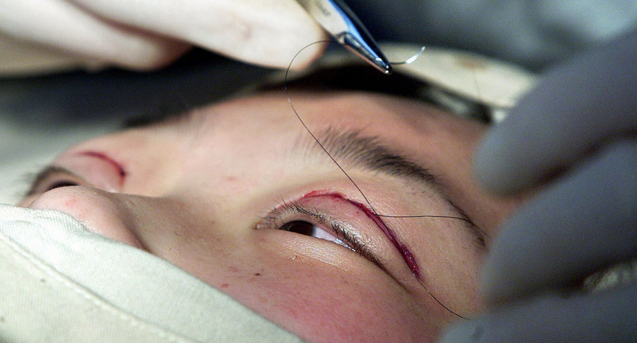Intervención quirúrgica en un ojo