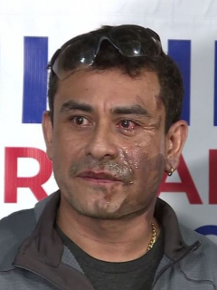 Peruano atacado con ácido.