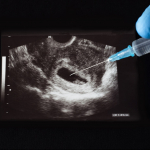 Aborto
