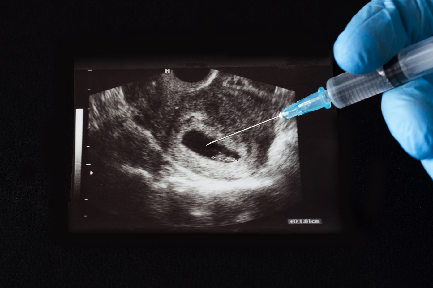 Aborto