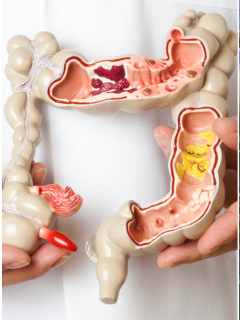 Imagen de cáncer de colon y Chadwick Boseman, a propósito de aumento en cifras de la enfermedad