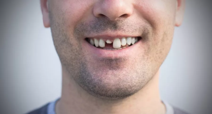 Imagen de hombre con un diente roto que ilustra nota sobre por qué ha aumentado el número de personas con dientes quebrados durante la pandemia.