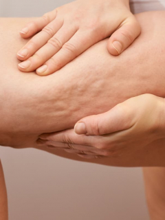 Persona señalando celulitis para ilustrar nota sobre qué es, por qué aparece y cuáles son las zonas del cuerpo más afectadas