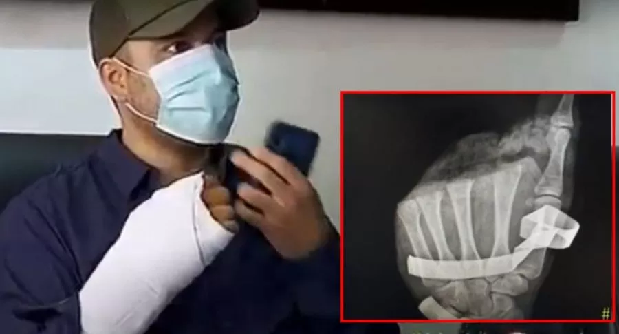 Policía de Bogotá al que le implantaron pedazo de mano que le habían amputado con un machete 