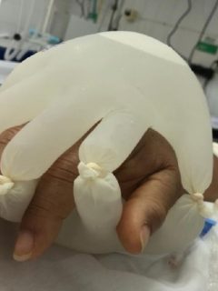 Enfermera diseña en Brasil una ‘mano’ con guantes y agua tibia para que pacientes con COVID-19 no se sientan solos en UCI.