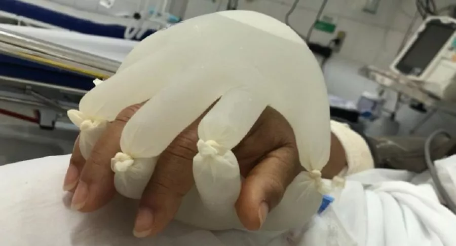 Enfermera diseña en Brasil una ‘mano’ con guantes y agua tibia para que pacientes con COVID-19 no se sientan solos en UCI. 