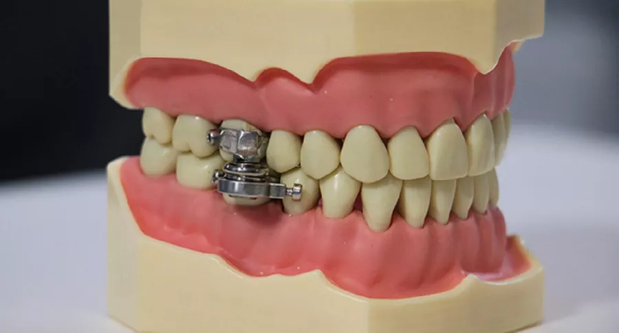 Obesidad: crean dispositivo para adelgazar instalado en los dientes