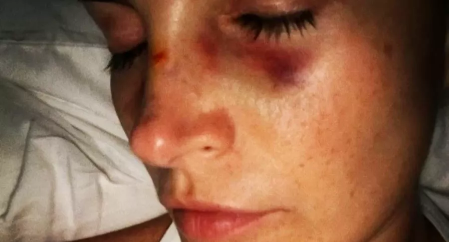 Foto de Juliana Galvis, en nota de foto con el rostro golpeado y relato de qué pasó.