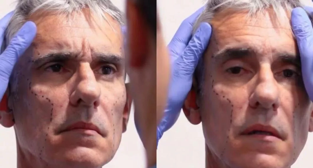 Miguel Varoni: cirujano cuenta detalles del rejuvenecimiento facial y corporal