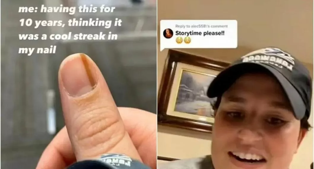 Una joven relató en un video que se ha hecho viral la forma cómo descubrió que una curiosa mancha en su uña no era benigna.