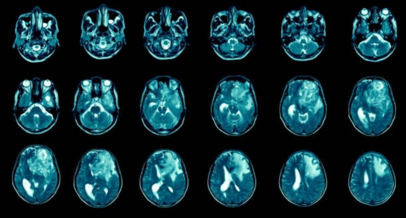 Imagen de los estudios que han hecho científicos en ratones para curar glioblastoma, un tumor cerebral