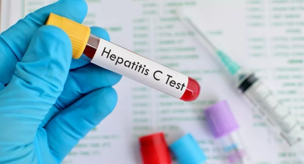 Confirman el primer caso de hepatitis aguda de origen desconocido en niños, en Colombia. A nivel mundial se han reportado 650.