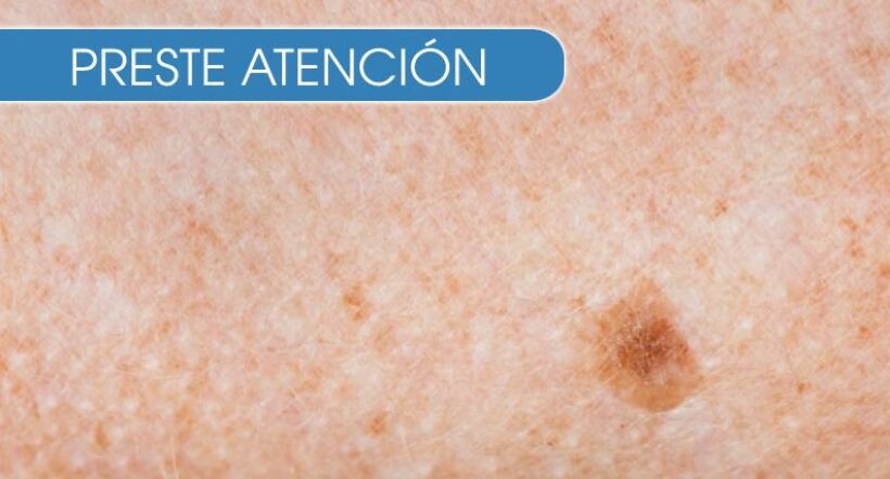 Imagen de la peil a propósito de cómo practicarse el autoexamen para prevenir el cáncer de piel