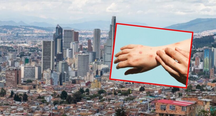 Bogotá es la ciudad con más casos de viruela del mono en Colombia
