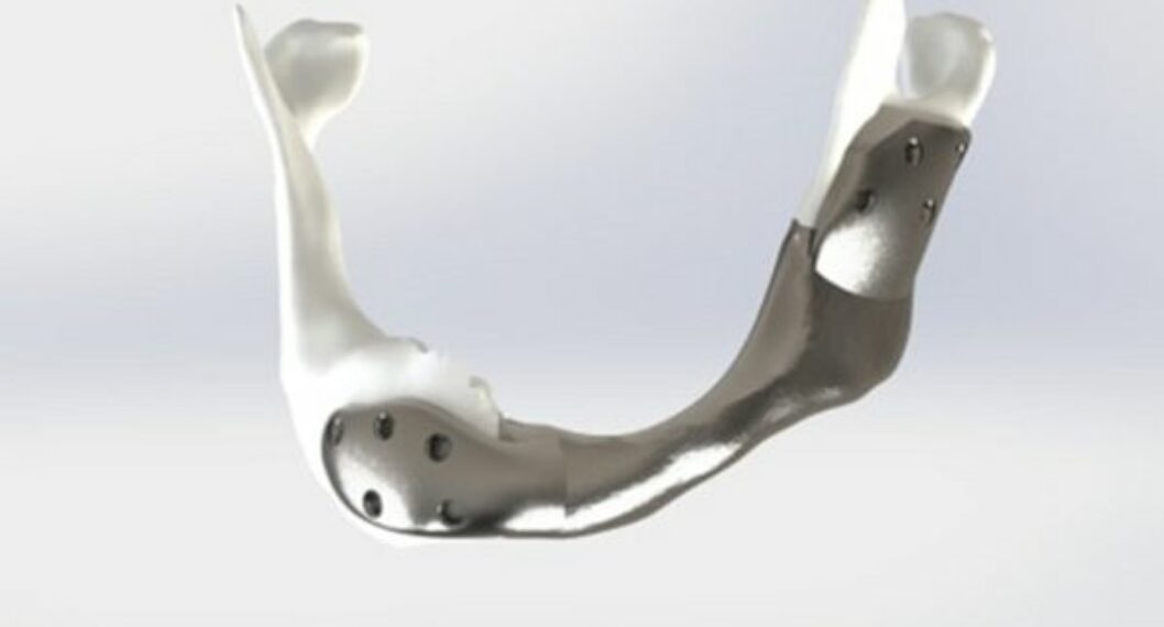 Trasplantan por primera vez en el mundo una mandíbula de titanio impresa en 3D