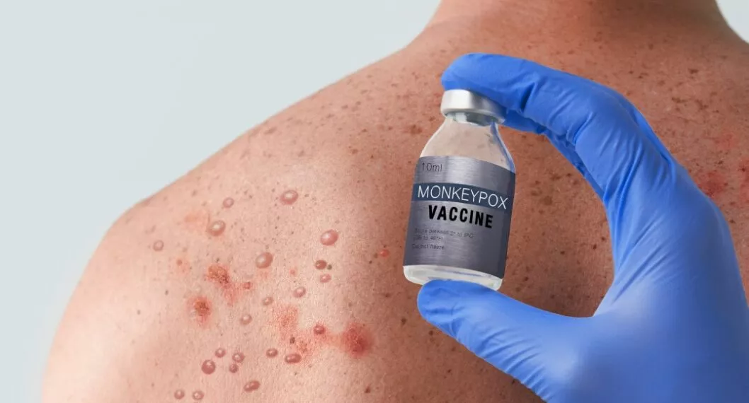 Minsalud confirmó que en las próximas semanas llegará el primer lote de vacunas contra la viruela del mono.