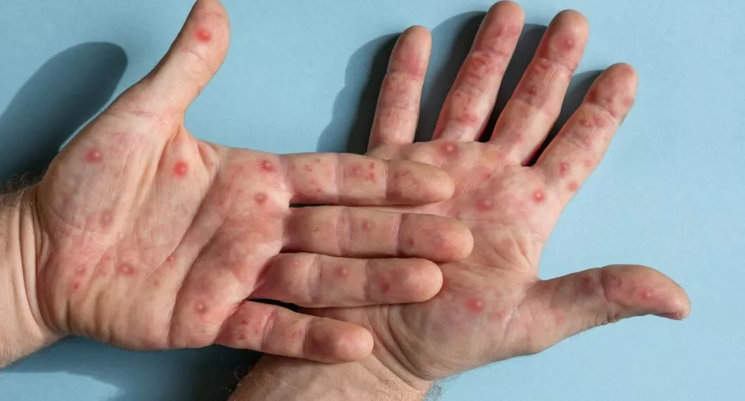 Palmas de las manos con ronchas; síntomas de viruela símica.