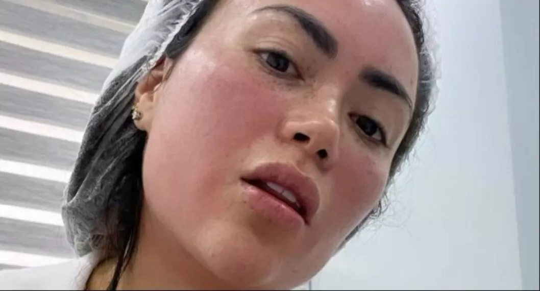 Daneidy Barrera, más conocida como 'Epa Colombia', pagó costoso tratamiento para mejorar el aspecto de la piel de su rostro. 