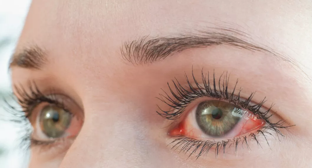 Mujer tenía 26 lentes de contacto en un ojo y casi pierde la vista 