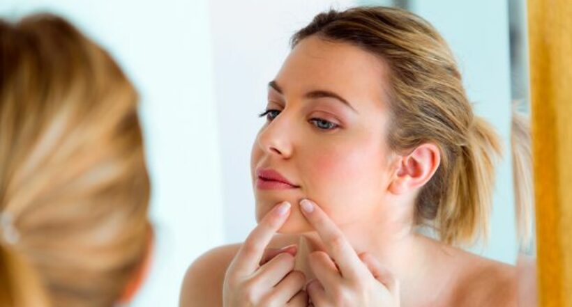 El acné se puede presentar en jóvenes y adultos por distintos factores que lo estimulan. 